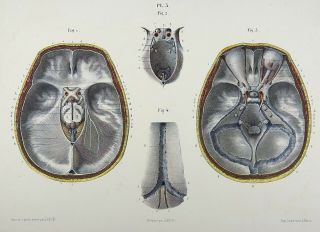 1853 Hirschfeld Anatomy Skull Hand Colour Masterpiece Medical Illustration