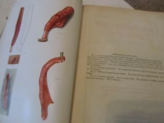Vermiform Appendix Diseases Book Kelly Hurdon c1905 1st Edition w/illustrations 5