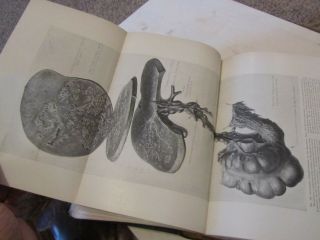 Vermiform Appendix Diseases Book Kelly Hurdon c1905 1st Edition w/illustrations 7