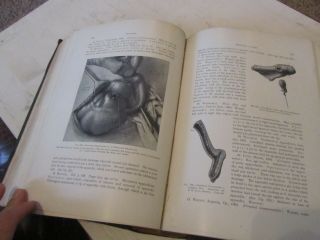 Vermiform Appendix Diseases Book Kelly Hurdon c1905 1st Edition w/illustrations 9
