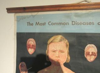 VINTAGE MEDICAL POSTER 1950 ' S 1960 ' S CHILDHOOD DISEASES CLOTH ADAM ROUILLY & CO 2