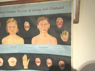 VINTAGE MEDICAL POSTER 1950 ' S 1960 ' S CHILDHOOD DISEASES CLOTH ADAM ROUILLY & CO 4