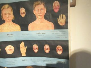 VINTAGE MEDICAL POSTER 1950 ' S 1960 ' S CHILDHOOD DISEASES CLOTH ADAM ROUILLY & CO 6