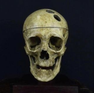 Victorian Trephined Medical Skull