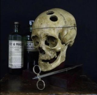 Victorian Trephined Medical Skull 2