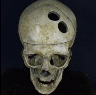 Victorian Trephined Medical Skull 3