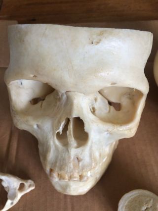 REAL Human Skull Medical Dental Teaching Training Vintage rare heavy Old Patina 4