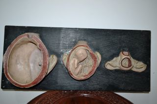 Antique Plaster/papier Mâché Section Anatomical Model.  Womb With The Fetus.  1930s