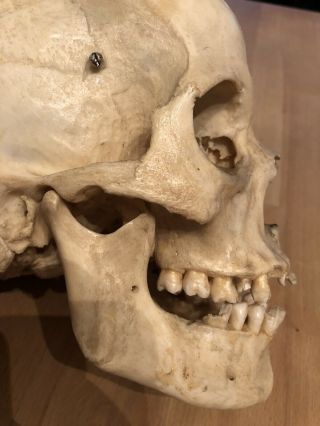 REAL Human Skull Medical Dental Teaching Training Vintage rare And Old 11