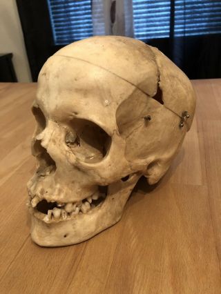 Real Human Skull Medical Dental Teaching Training Vintage Rare And Old