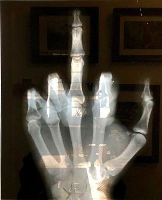 Human Hand Middle Finger X - Ray Art - Photograph Picture - Unique - Family