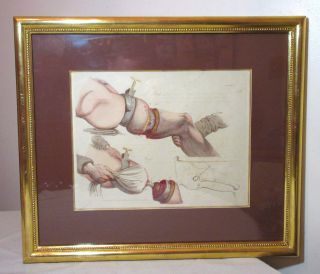 Rare Antique 1820 Hand Colored Amputation Medical Doctor Engraving Print Etching